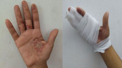 ওষুধ নেই, পচন ধরছে গাজার নারীদের হাতে