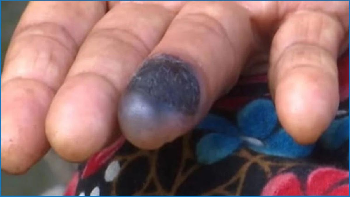 রংপুরে অ্যানথ্রাক্স শনাক্ত, এলাকায় আতঙ্ক