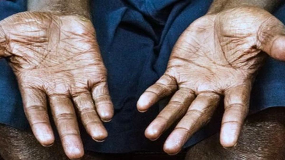 কুষ্ঠরোগে ভোগান্তি, শ্যামনগরে নেই বিশেষজ্ঞ চিকিৎসক