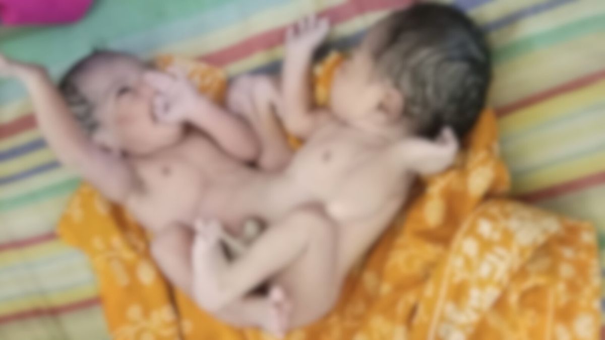 চাঁদপুরে দুই মাথা নিয়ে শিশুর জন্ম