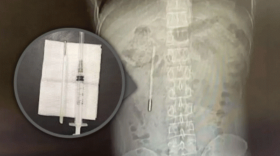 গিলে ফেলা থার্মোমিটার তরুণের পেটে ছিল ২০ বছর