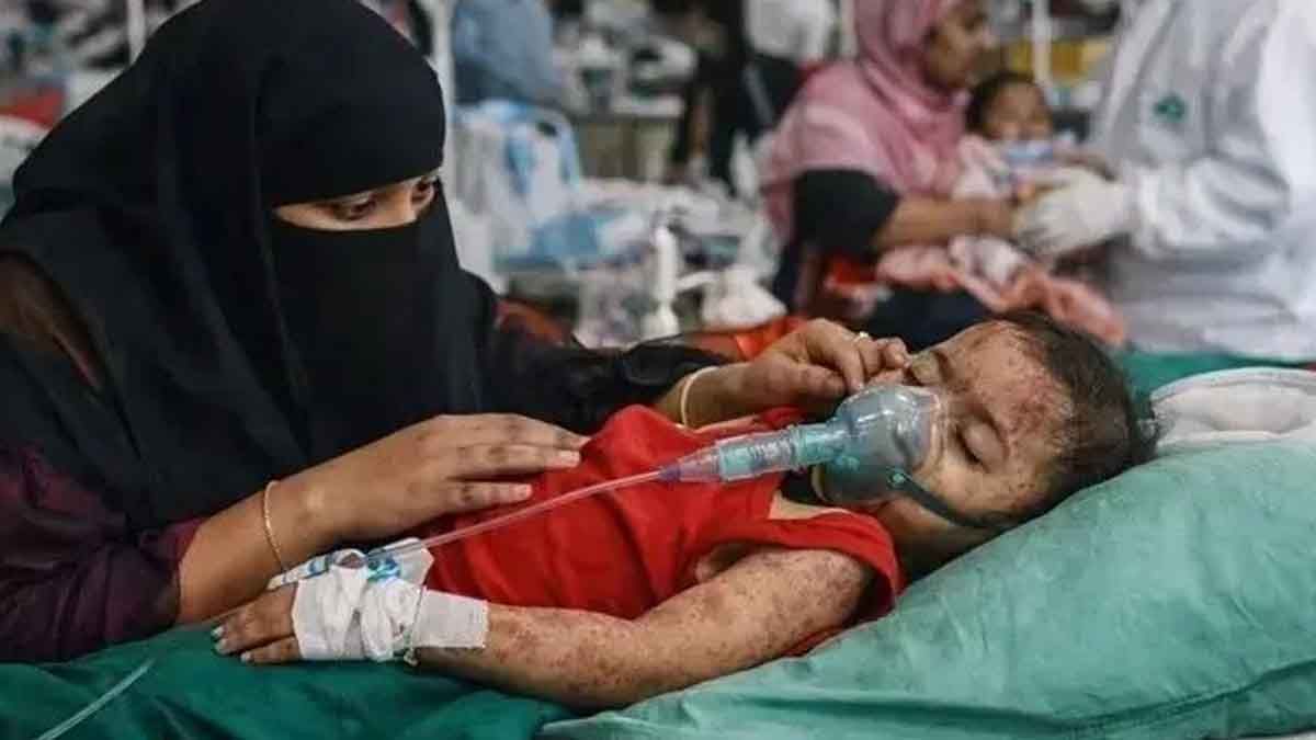 দেশে হাম ও হাম সন্দেহে শিশু মৃত্যু ২৫০ ছাড়াল