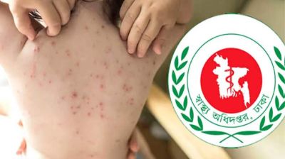 হামের উপসর্গে আরও ৫ শিশুর মৃত্যু