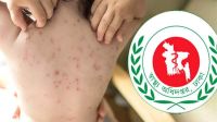 হামের উপসর্গে আরও ৫ শিশুর মৃত্যু