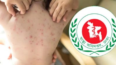 হামের উপসর্গে আরও ১ মৃত্যু, মোট ৬৫৭