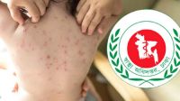 হামের উপসর্গে আরও ১ মৃত্যু, মোট ৬৫৭