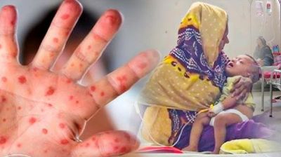 হাম উপসর্গ নিয়ে আরও ৮ শিশুর মৃত্যু, আক্রান্ত ১১৭১