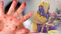 হাম উপসর্গ নিয়ে আরও ৮ শিশুর মৃত্যু, আক্রান্ত ১১৭১