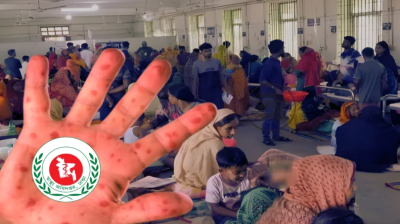 হাম ও  উপসর্গে আরও ৫ শিশুর মৃত্যু, আক্রান্ত ১০২৫