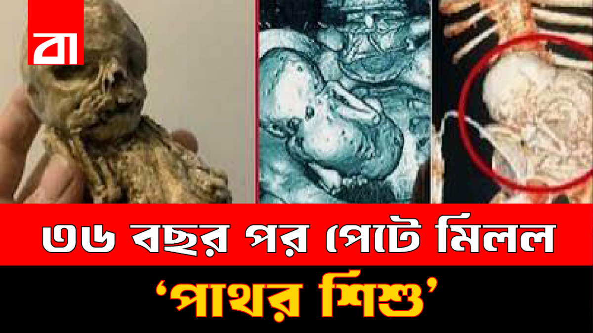 প্রসবের ভয়ে হাসপাতাল ছাড়েন, ৩৬ বছর পর পেটে মিলল ‘পাথর শিশু’