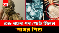 প্রসবের ভয়ে হাসপাতাল ছাড়েন, ৩৬ বছর পর পেটে মিলল ‘পাথর শিশু’